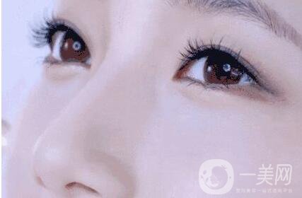 三點(diǎn)定位雙眼皮多少錢 雙眼皮手術(shù)方法