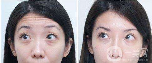 去抬頭紋要多少錢 去抬頭紋的手術(shù)方法