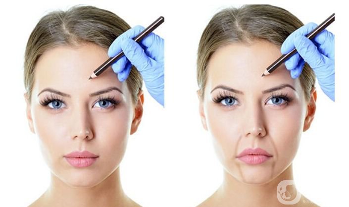 去法令紋多少錢 去法令紋的手術方法