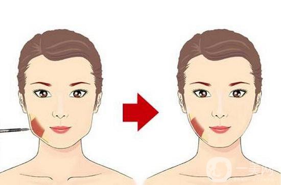 面部光纖溶脂*果 面部光纖溶脂作用