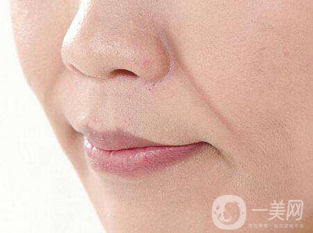 注射伊維蘭除皺多少錢(qián) 伊維蘭除皺*果好不好