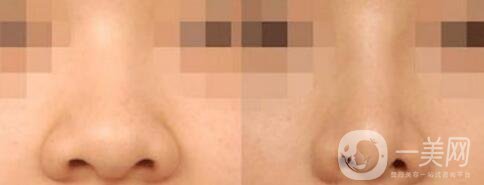 做縮小鼻翼多少錢,鼻翼縮小注意什么