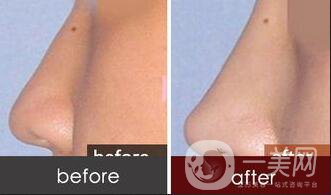 墊鼻尖,墊鼻尖手術方法