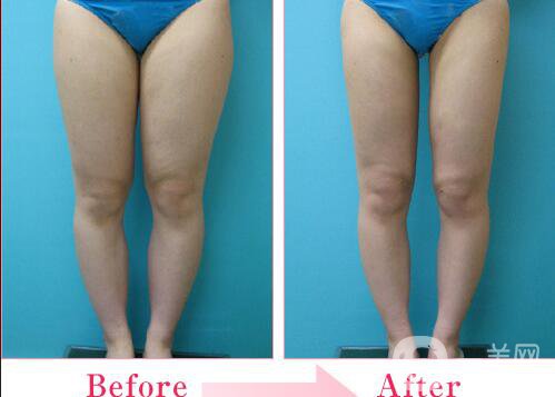 大腿吸脂多少錢,大腿吸脂術(shù)后護理