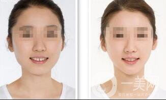 做下頜角后腫多久