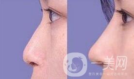 鼻骨矯正多久恢復,鼻骨矯正術(shù)后護理