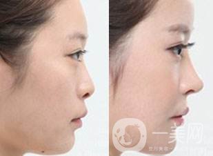 注射隆鼻前后圖 注射隆鼻如何護理