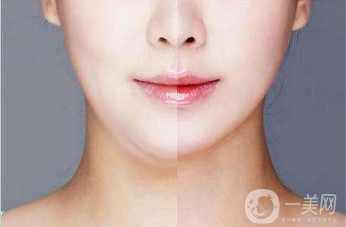 面部吸脂修復(fù)手術(shù)多少錢 面部吸脂恢復(fù)時間