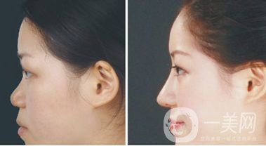 打完玻尿酸注意事項(xiàng) 玻尿酸有什么作用