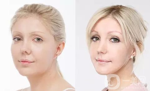 做完磨骨多久可以恢復自然 *果好不好