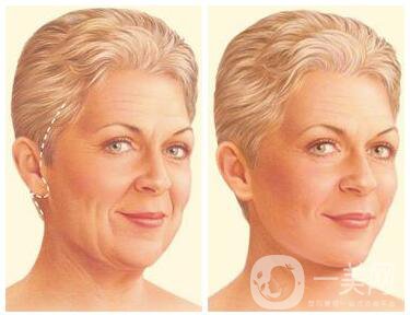 韓國吸血鬼面部提升術(shù)是什么？它有什么不同？