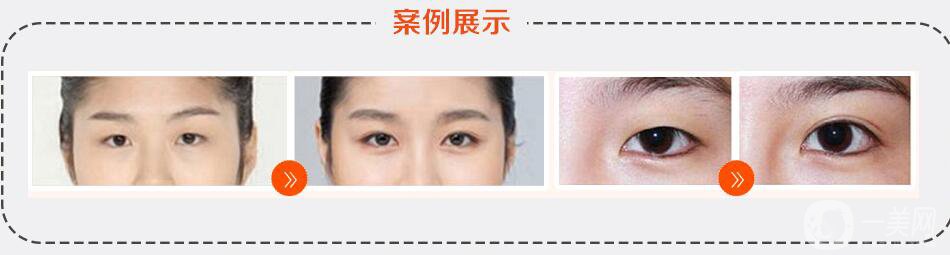 杭州臻美整形價格表2019版搶先看