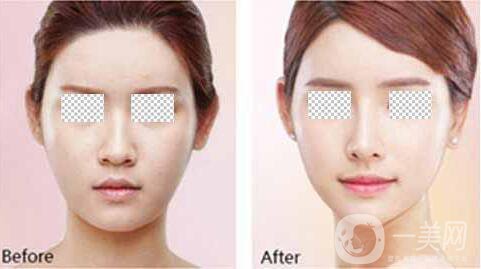 深圳假體豐眉弓手術(shù)費(fèi)用 眉弓手術(shù)*嗎