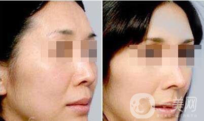 北京自體脂肪豐眉弓多少錢 *果怎么樣？