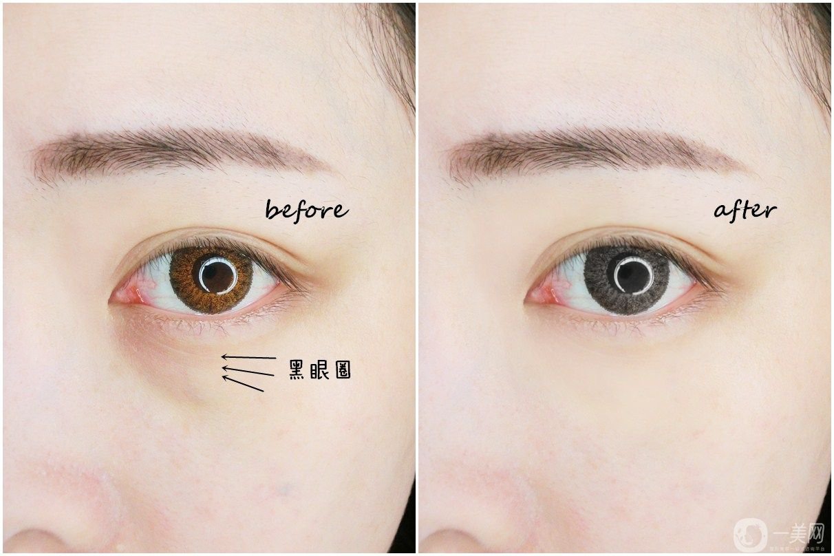 玻尿酸去黑眼圈術(shù)前準(zhǔn)備 玻尿酸去黑眼圈*果如何
