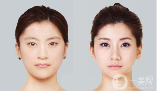 廣東做縮小鼻翼手術(shù)是多少錢 *果怎么樣