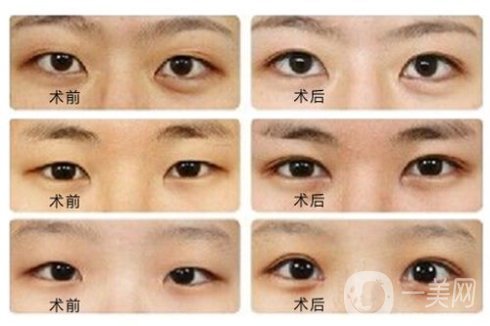 開(kāi)眼角前后