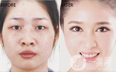 深圳墊鼻尖要多少錢(qián) 墊鼻尖*嗎