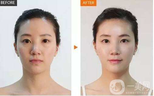 怎么才能去掉魚尾紋 去魚尾紋方法