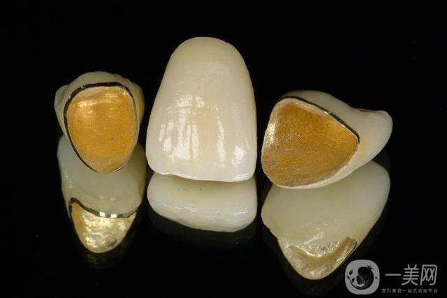 黃金烤瓷牙價(jià)格一般是多少？