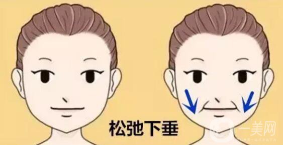 法令紋怎么祛除*果比較好？