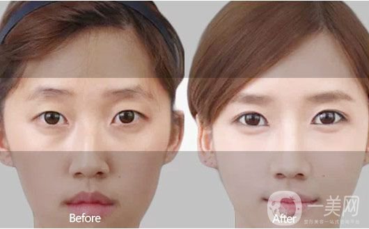 埋線雙眼皮好不好？埋線雙眼皮*果圖