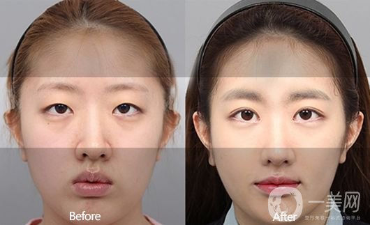 埋線雙眼皮好不好？埋線雙眼皮*果圖