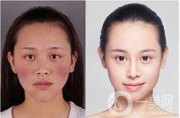 臉上很多紅血絲怎么辦？給你1個小法寶和紅血絲說再見