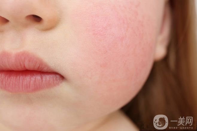 臉上很多紅血絲怎么辦？給你1個小法寶和紅血絲說再見