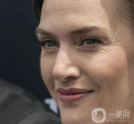 祛除眼角魚尾紋方法有哪些？價(jià)格一般是多少呢？