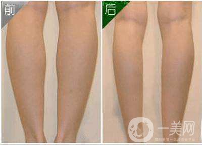 打*要多少錢 *的品牌有哪些