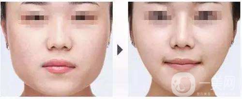 打*前后*果圖 *的價格是多少