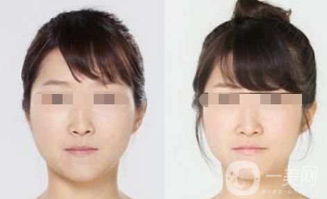 *要花多少錢(qián) Botox的優(yōu)勢(shì)有哪些