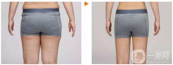 吸脂手術(shù)類型有哪些？