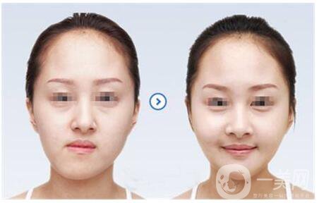 正頜手術(shù)的方法有哪些？