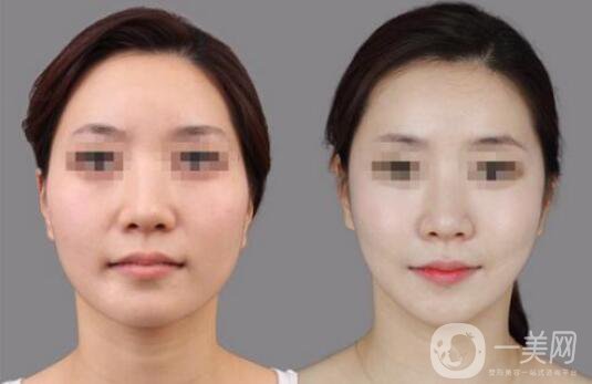 顴骨整形手術(shù)的方法有哪些？