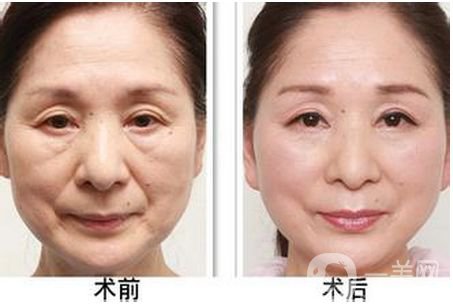 熱瑪吉一次多少錢 熱瑪吉祛皺*果