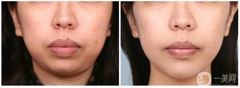 改臉型需要多少錢 面部整形有哪些