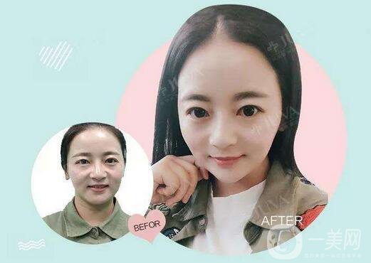 關(guān)于注射美容，你得了解這幾點(diǎn)干貨！