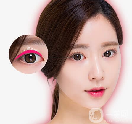 亞韓割雙眼皮多少錢？