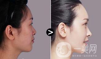 隆鼻多少錢,隆鼻術后注意事項