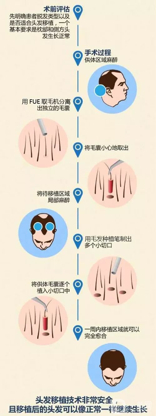 毛發(fā)移植*果怎么樣？毛發(fā)移植原理是什么？