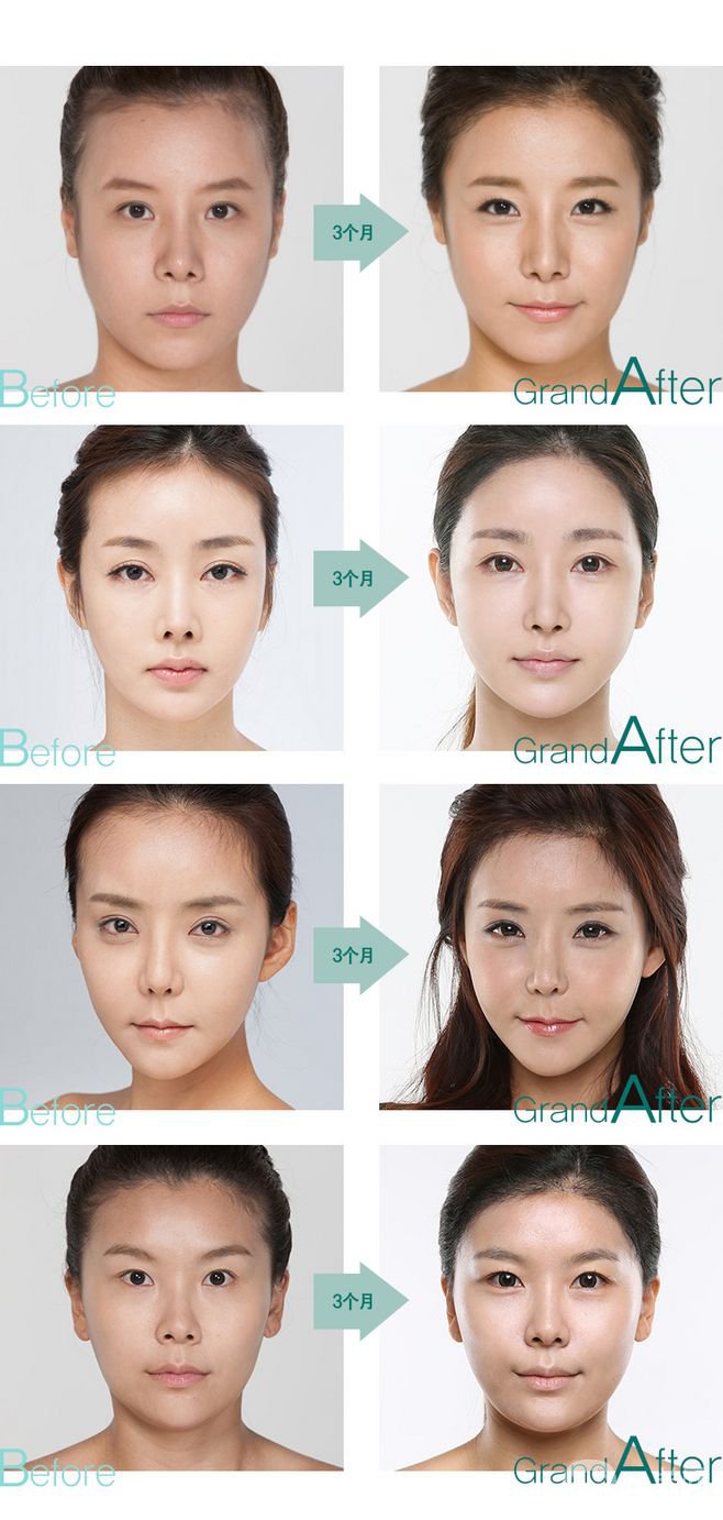 毛發(fā)移植*果怎么樣？毛發(fā)移植原理是什么？