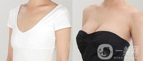 自體脂肪隆胸手術(shù)多少錢 *嗎？