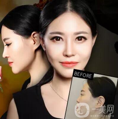 隆鼻手術(shù)一般多少錢(qián)？?jī)r(jià)格高不高？