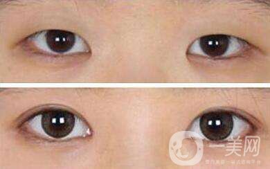 韓式微創(chuàng)雙眼皮會反彈嗎 *果怎么樣