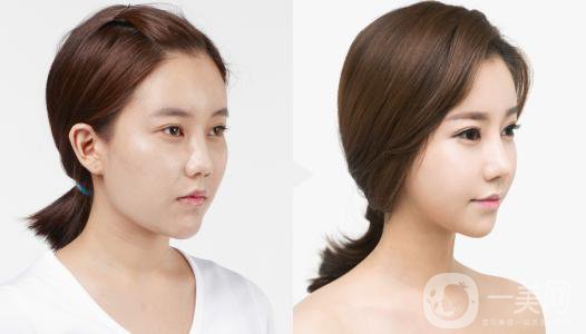 印度班加羅爾下巴整容手術(shù)費(fèi)用 頜骨整容手術(shù)*果