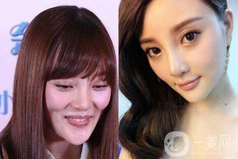 又一個(gè)整容失敗的女明星，鼻子都整歪了，不甘心揚(yáng)言還要植發(fā)！