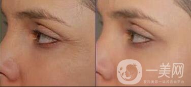 深圳電波拉皮去皺價(jià)格,深圳電波拉皮去皺*果