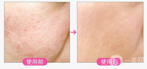 彩光祛痘印前后 彩光祛痘*果怎么樣 會(huì)復(fù)發(fā)嗎？	